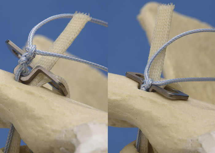 The tendon graft shares the clavicular drill hole with the supportive No. 5 suture. The suture knots fit into the Clavicular Clip loop (Left). Once the sutures are tied the Clavicular Clip loop is allowed to sink into the clavicular drill hole hiding the suture knot (Right).